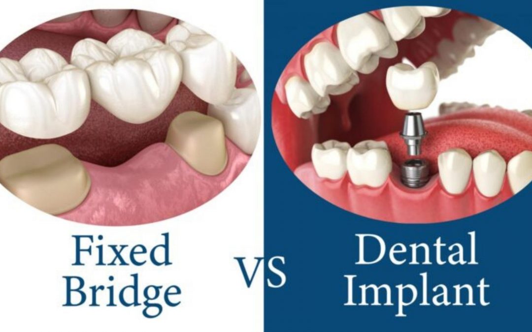 Are Dental Implants Better Than A Bridge – 2022