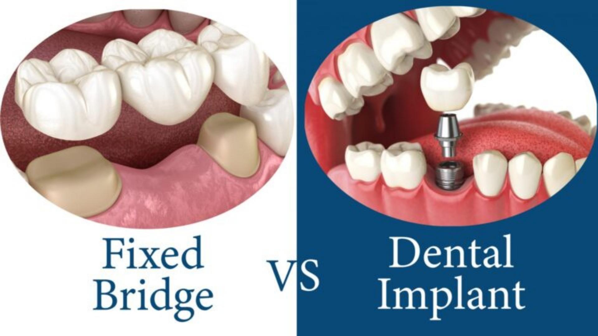 Dental Implants VS Bridge Dentist In Brampton Dentistry On Main
