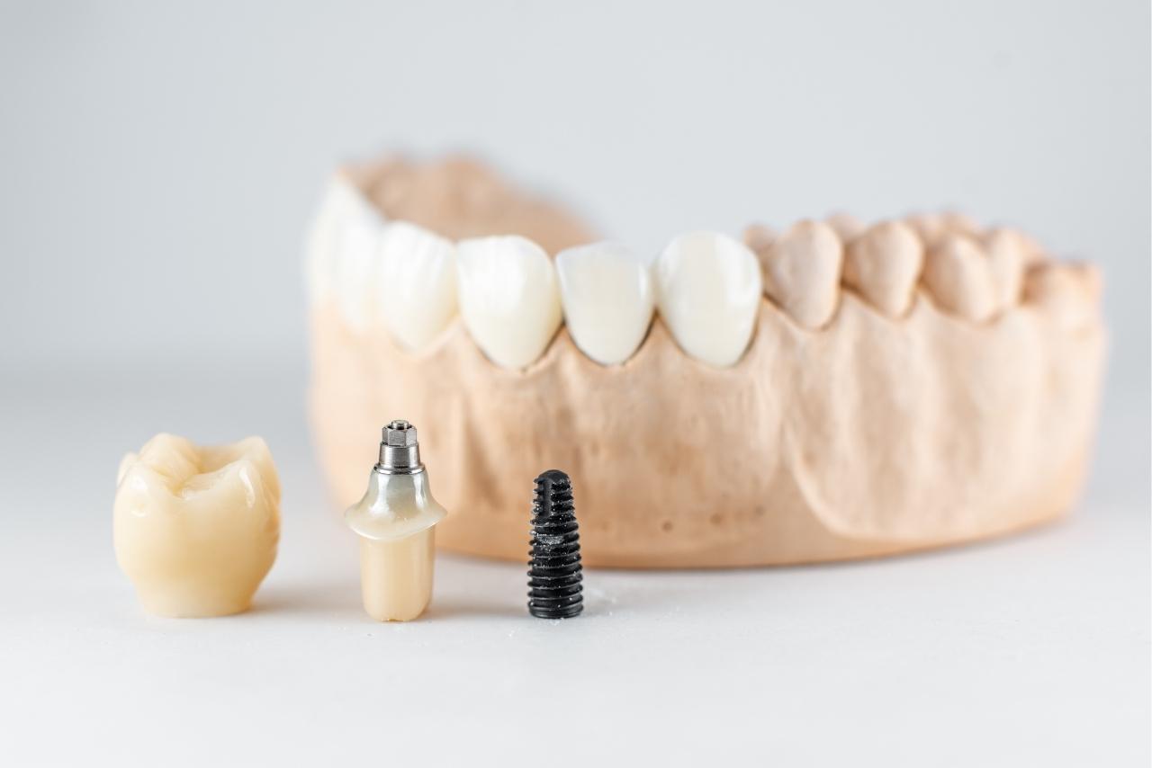 Dental Implants - Brampton Dentist