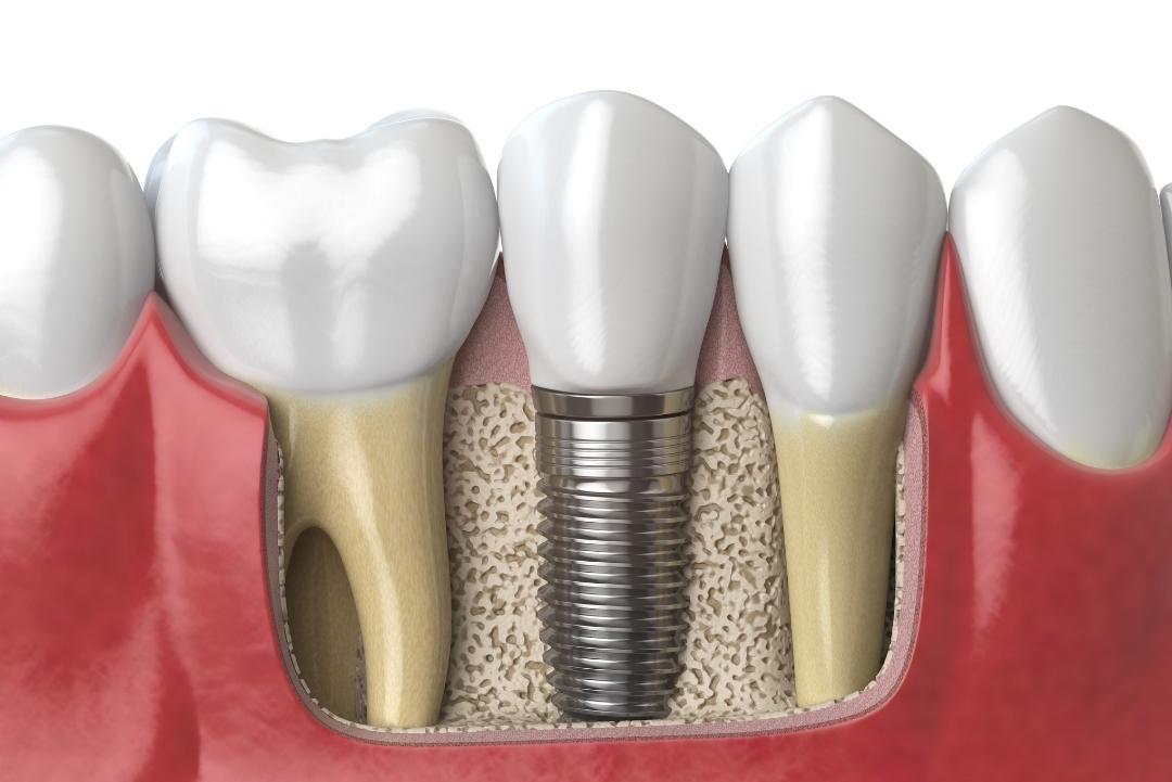 Dentist In Brampton Dental Implants
