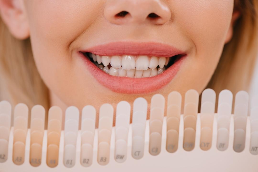 Dentist In Brampton Teeth Whitening (1)