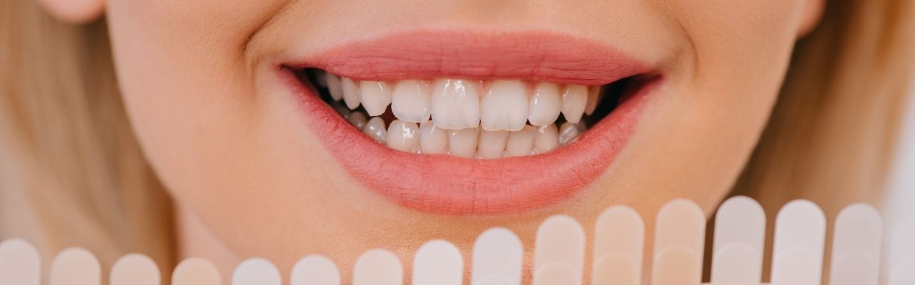 Dentist In Brampton Teeth Whitening Services (1280 x 400 px)