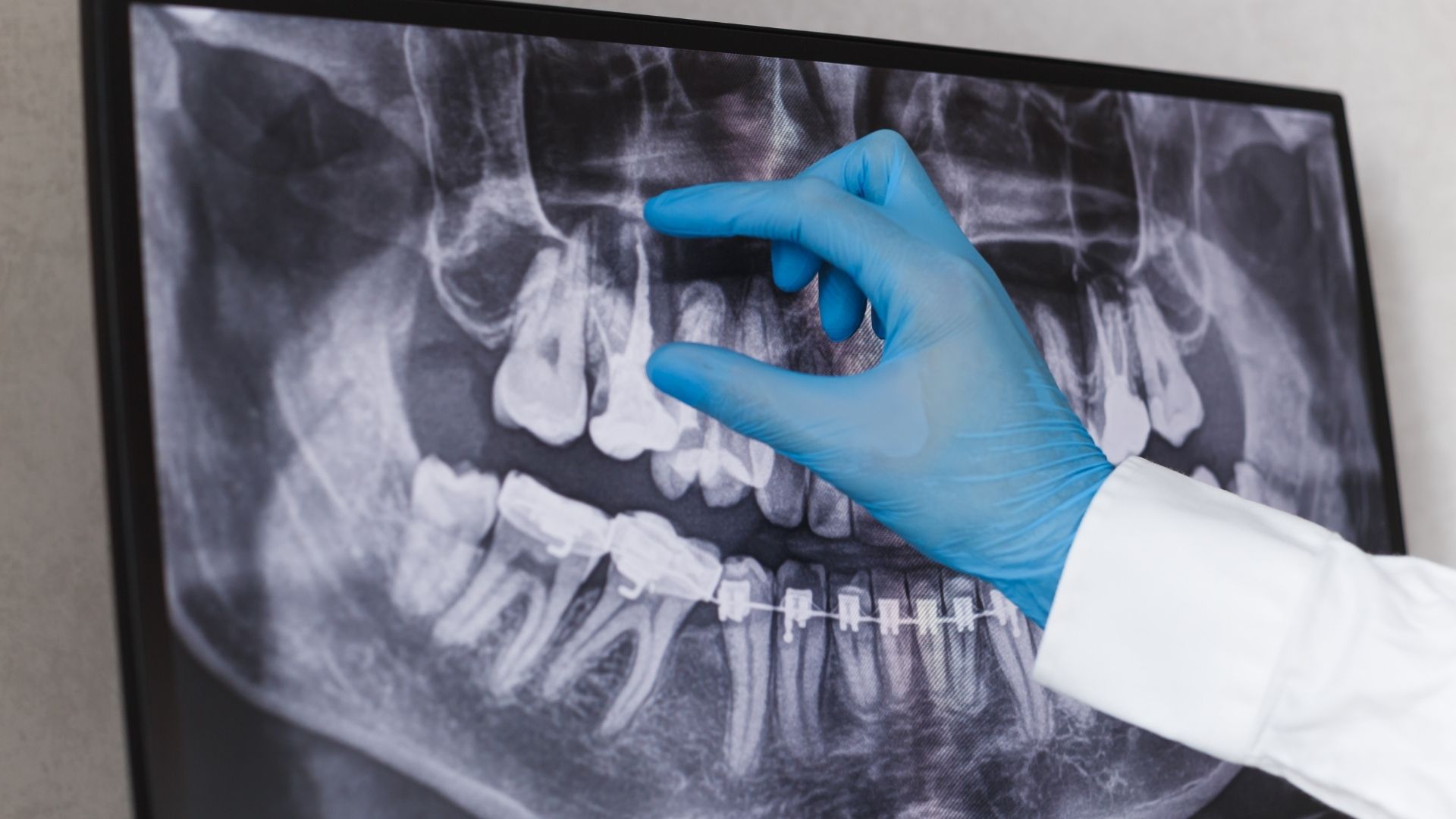 Root Canal Therapy- Dentist In Brampton