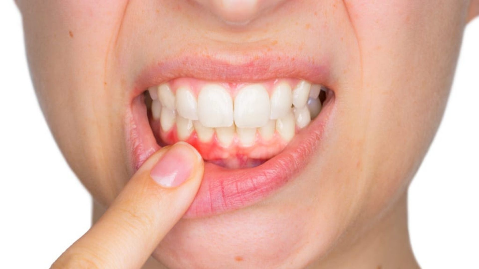5 Causes of Bleeding Gums 2022 - Brampton Dentist