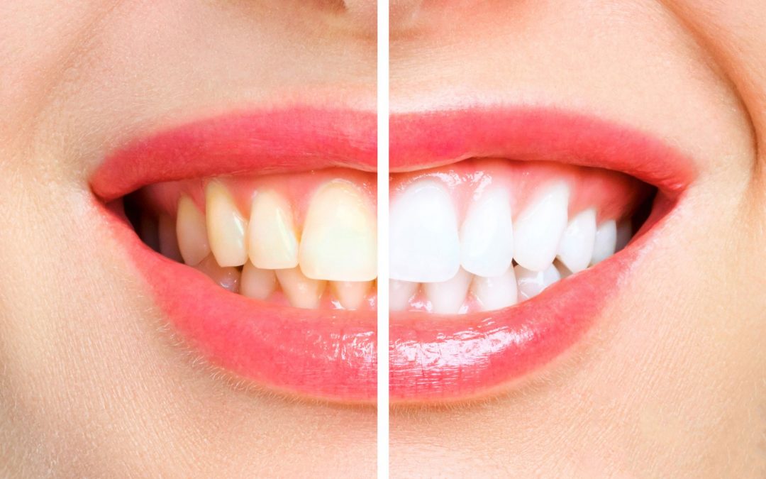 Teeth Whitening At the Dentist In Brampton.  How to whiten teeth and keep them white.