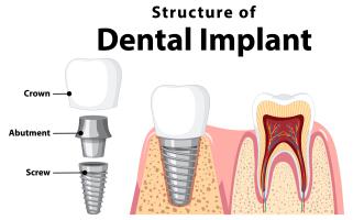 Dental Implants in Brampton